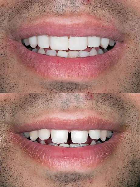 Before and after pediatric dental treatment showing restoration of a chipped front tooth