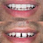 Before and after pediatric dental treatment showing restoration of a chipped front tooth