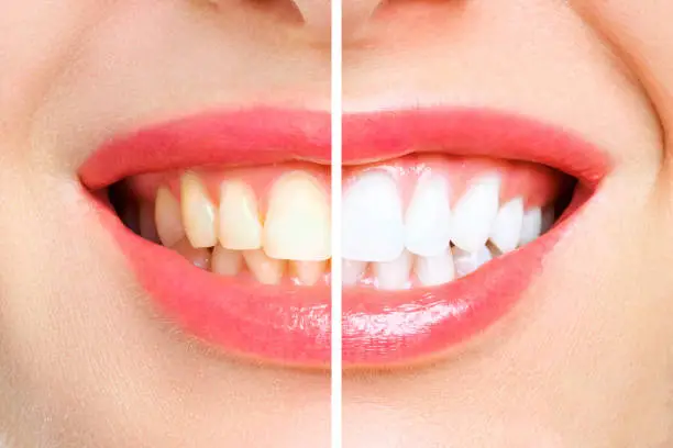 Before and after cosmetic dental treatment showing significant improvement in tooth shade