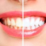 Before and after cosmetic dental treatment showing significant improvement in tooth shade