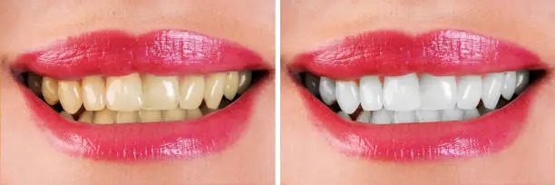 Before and after smile makeover treatment correcting discoloration and enhancing smile aesthetics