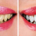 Before and after smile makeover treatment correcting discoloration and enhancing smile aesthetics
