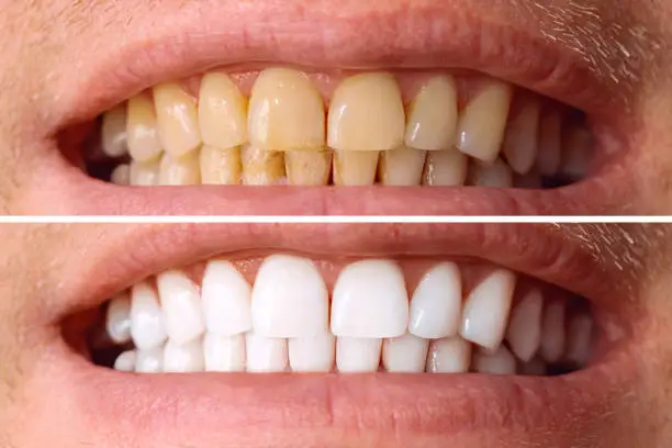 Before and after teeth whitening treatment improving tooth color and smile brightness