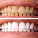 Before and after teeth whitening treatment improving tooth color and smile brightness