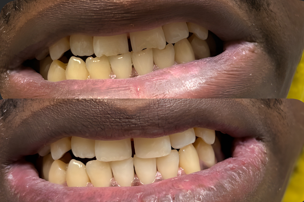 Before and after restorative dental treatment improving tooth alignment and appearance