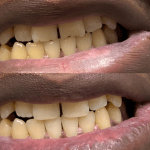 Before and after restorative dental treatment improving tooth alignment and appearance