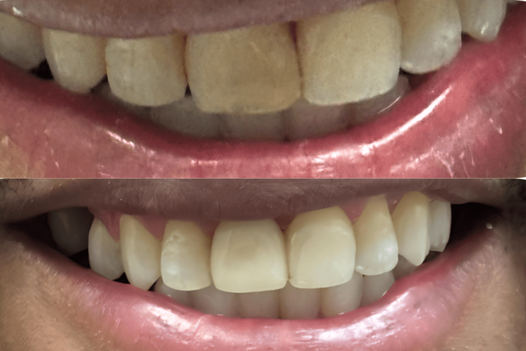 Before and after cosmetic dental treatment improving tooth color and smile appearance