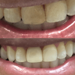 Before and after cosmetic dental treatment improving tooth color and smile appearance