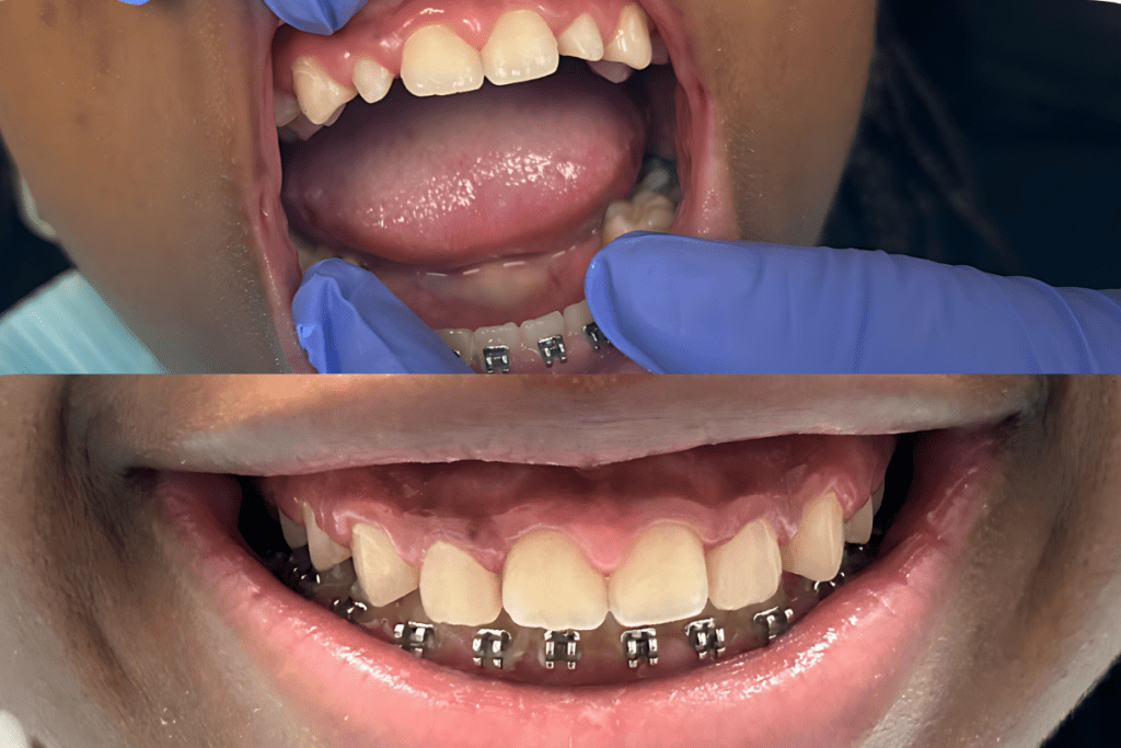 Before and after pediatric dental treatment restoring damaged front teeth