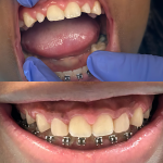 Before and after pediatric dental treatment restoring damaged front teeth