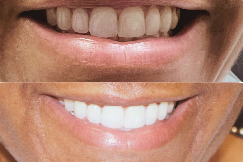 Before and after teeth whitening treatment resulting in a brighter and more confident smile