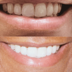 Before and after teeth whitening treatment resulting in a brighter and more confident smile